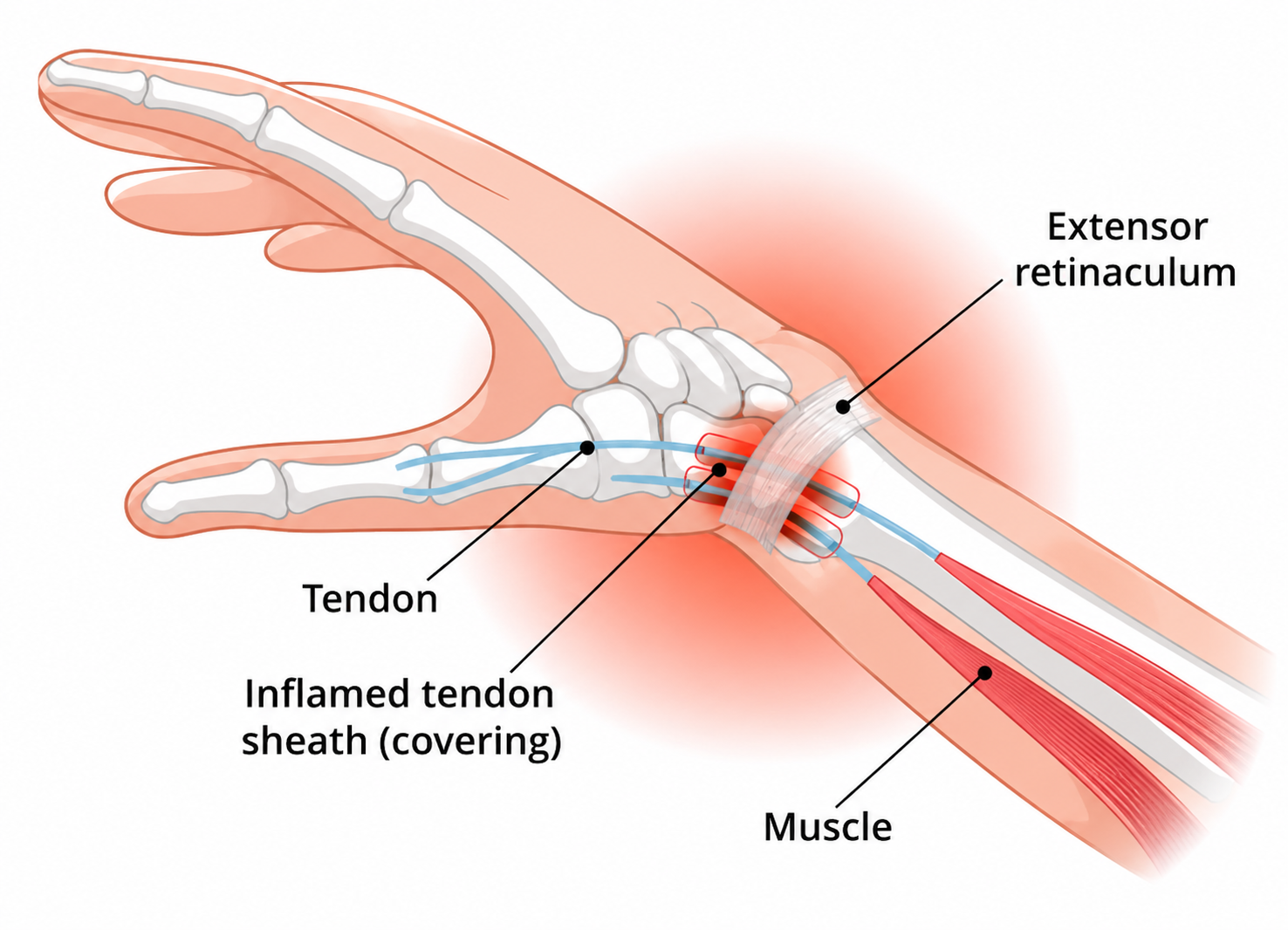 De Quervain's Tenosynovitis